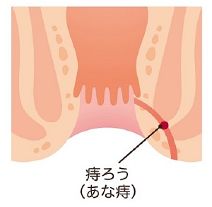 あな痔