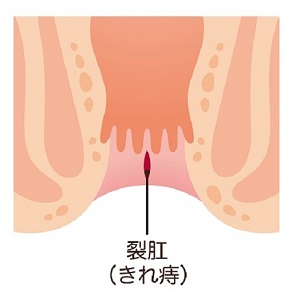 切れ痔