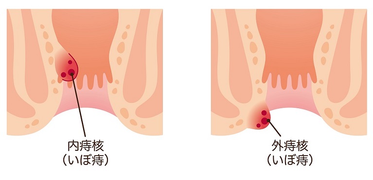 いぼ痔