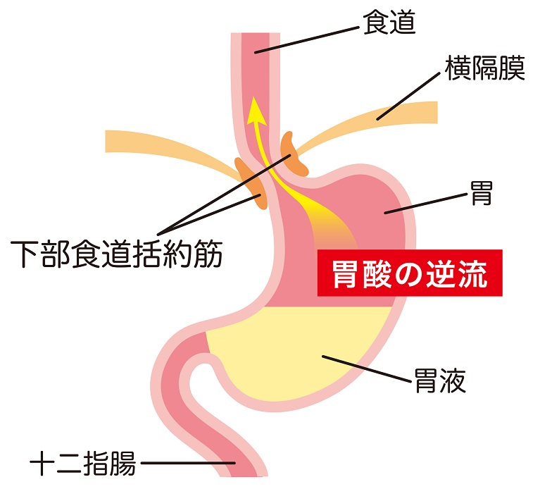 胃逆流性食道炎（GERD）・逆流性食道炎