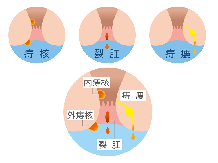 痔について